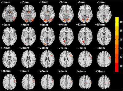 Amplitude of Low-Frequency Fluctuation With Different Clinical Outcomes in Patients With Generalized Tonic–Clonic Seizures